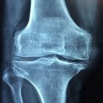 Why the quantity of uric acid increases | Symptoms of increased uric acid | Carrot juice for control of uric acid | Lemonade will reduce uric acid